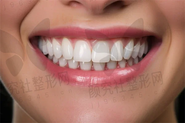 深圳牙齿美白费用是多少？2025年牙齿美白价格一览，顺便提及氟斑牙治疗的相关费用。