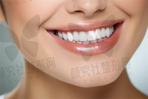 绍兴牙齿美白费用是多少？2025年牙齿美白价格一览，附超薄瓷贴面美白费用简述。